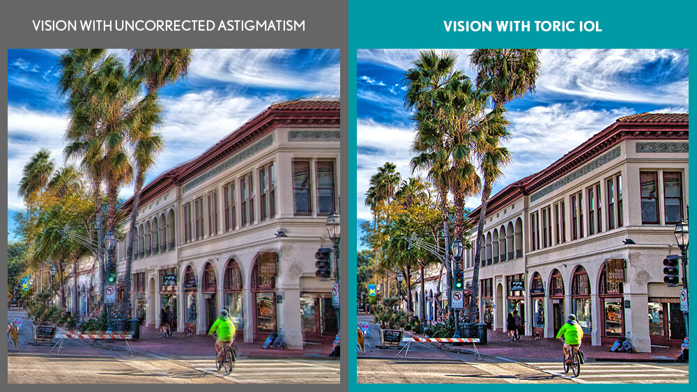 Vision With Incorrected Astigmatism VS Vision With Toric IOL